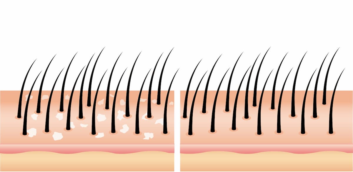 perte de cheveux pellicules