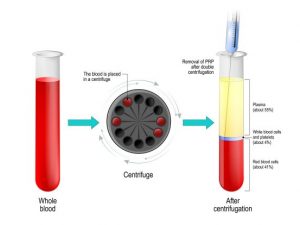 méthode prp